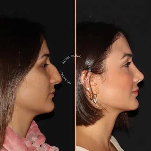 rhinoplasty-result11