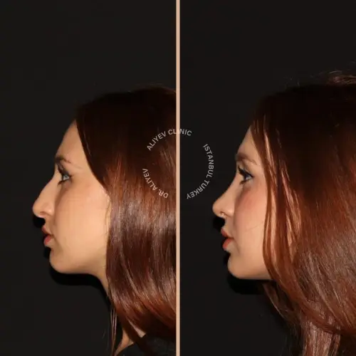 rhinoplasty-result12