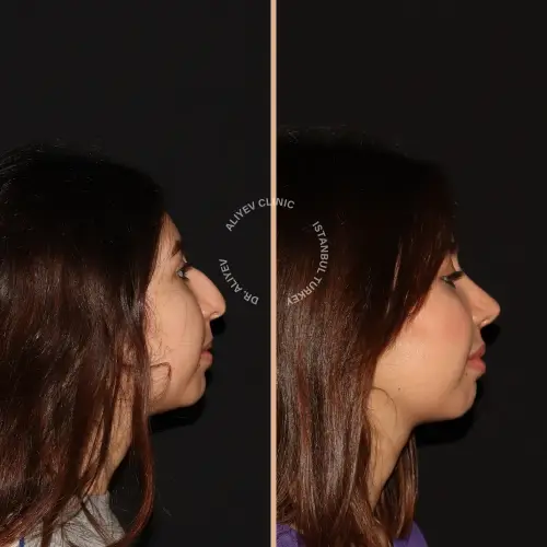 rhinoplasty-result13