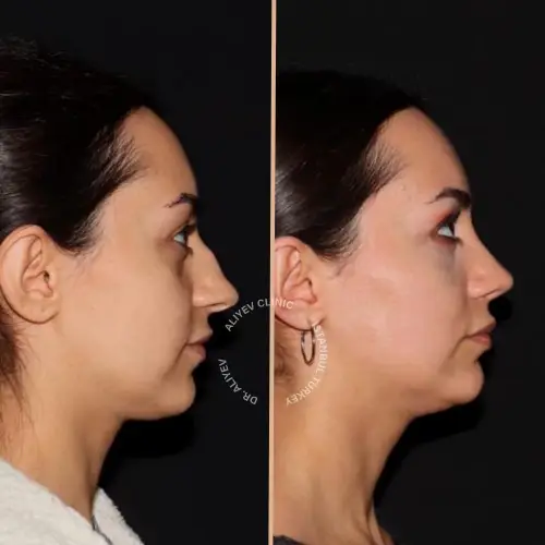 rhinoplasty-result3