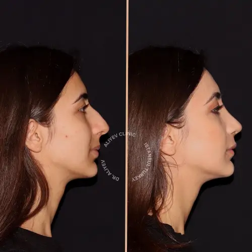 rhinoplasty-result4