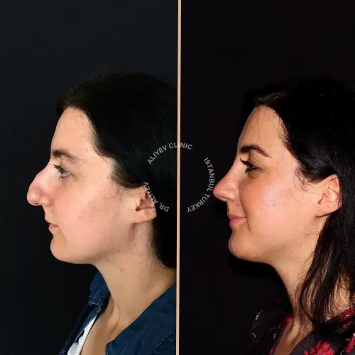 rhinoplasty-result5