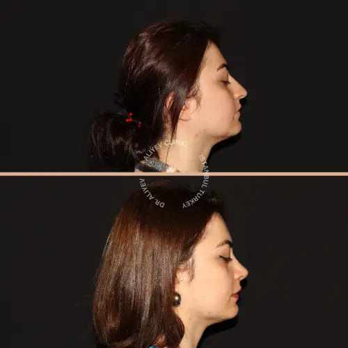 rhinoplasty-result9